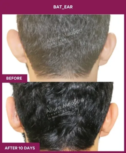 Ear Correction Surgery 4 Ear Correction Surgery in Mumbai, India
