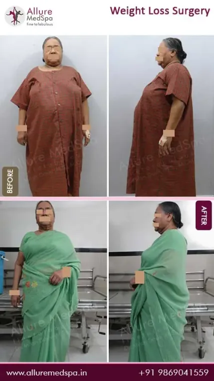 Bariatric-Surgery-Before-and-After-Gallery-in-Mumbai-India