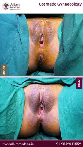 Cosmetic-Gynaecology-Before-After-Images-Mumbai (1)