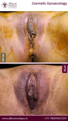 Cosmetic-Gynaecology-Before-After-Images-Mumbai-India (1)