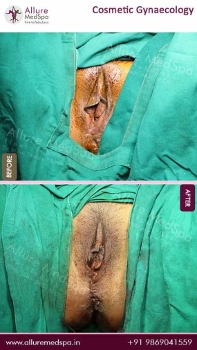 Cosmetic-Gynaecology-Before-After-Result-Mumbai
