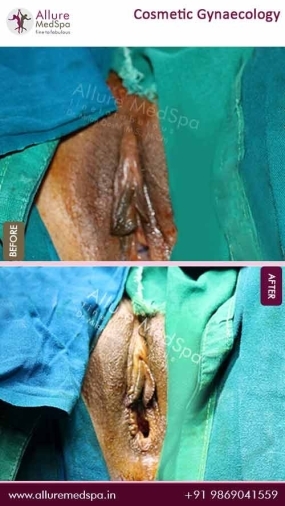 Cosmetic-Gynaecology-Before-After-Result-Mumbai-India