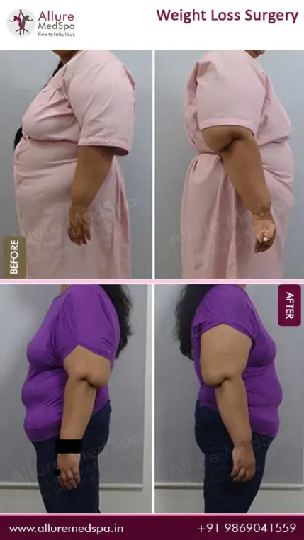 Weight-Loss-Before-and-After-Images-in-Mumbai-India
