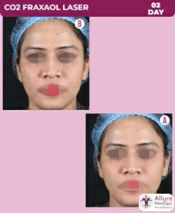 co2-fraxal-laser-treatment-before-after-image-247x300