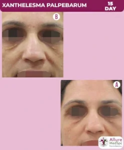 co2-fraxal-laser-treatment-before-after-result-247x300