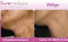 thumbs_vitiligo-before-after-gallery_0