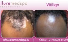 thumbs_vitiligo-before-after-images
