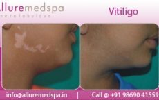 thumbs_vitiligo-before-after-photos
