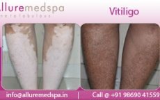 thumbs_vitiligo-before-after-surgery