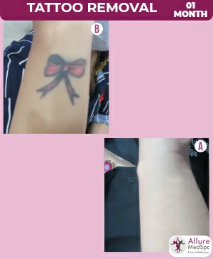 Tattoo removal treatment in Mumbai