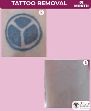Tattoo removal treatment in Mumbai