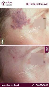 Birthmark-Removal-Before-and-After-Pictures-in-Mumbai-India