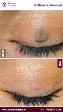 Birthmark-Removal-Treatment-Before-and-After-Images-in-Mumbai-India