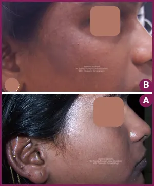 Dr.Shweta-best-four-PigmentationBA-image-2