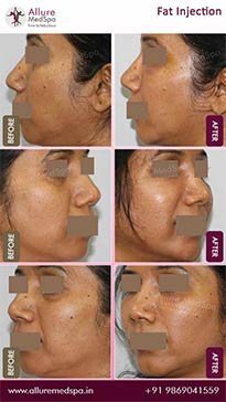 Fat-Garfting-Before-and-After-Gallery