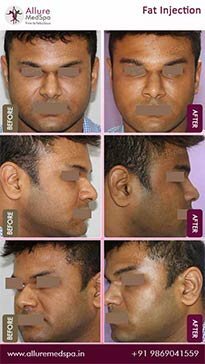 Fat-Garfting-Before-and-After-Images