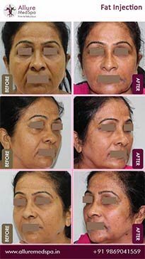 Fat-Injection-Before-and-After-Photos