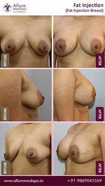 Fat-Transfer-Before-and-After-Gallery