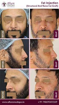 Fat-Transfer-Before-and-After-Images