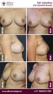 Fat-Transfer-Before-and-After-Photos