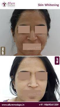 Skin-Brightening-Treatment-Before-and-After-Pictures