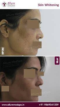 Skin-Lightening-Before-and-After-Images