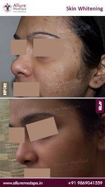 Skin-Lightening-Before-and-After-Result