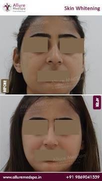 Skin-Lightening-Treatment-Before-and-After-Pictures