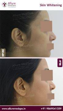 Skin-Whitening-Before-and-After-Images