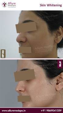 Skin-Whitening-Treatment-Before-and-After-Pictures