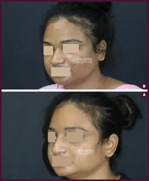 2020-07-026-RHINO-DORSAL-AUGMENTATION-1