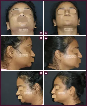 2020-07-026-RHINO-DORSAL-AUGMENTATION-2