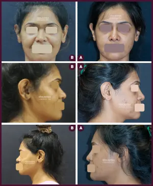 2020-09-021-REVISION-RHINOPLASTY-1