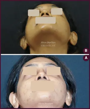 2020-09-021-REVISION-RHINOPLASTY-2