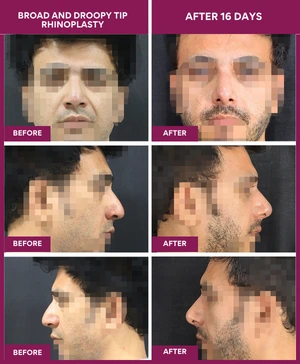 BROAD-AND-DROOPY-TIP-RHINOPLASTY