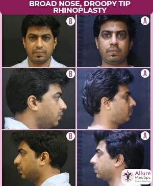 Broad-nose-droopy-tip-rhinoplasty