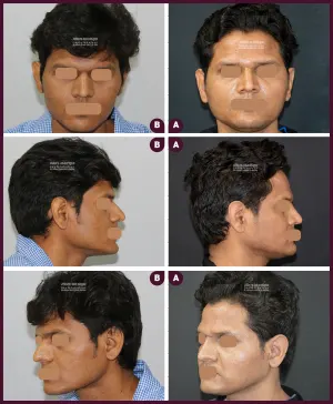 FN-ANGLE-2016-04-033-REVISION-RHINOPLASTY-1