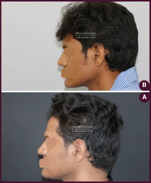 FN-ANGLE-2016-04-033-REVISION-RHINOPLASTY-2