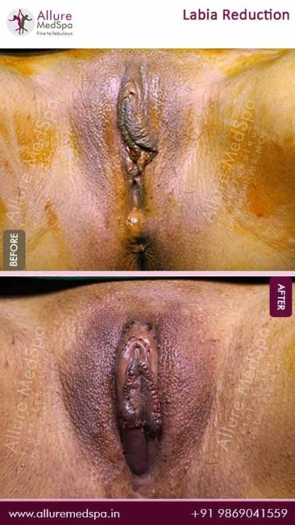 Labia-Reduction-Before-After-Image-Mumbai