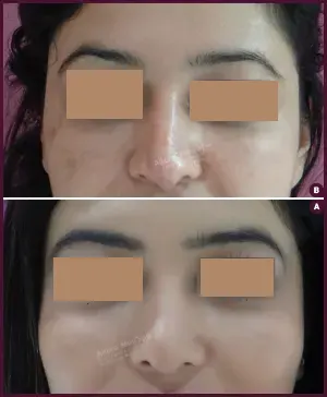 REVISION-RHINOPLSTY-1