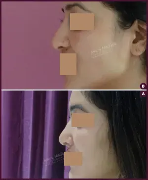 REVISION-RHINOPLSTY-2