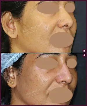 REVISION-RHINOPLSTY-4