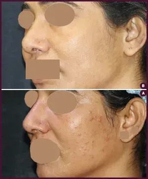 REVISION-RHINOPLSTY-5