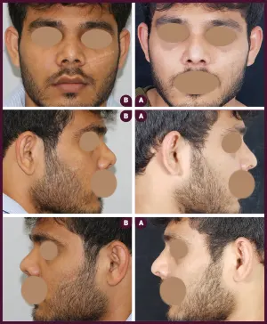 REVISION-RHINOPLSTY-6