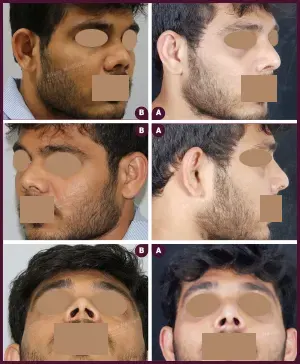 REVISION-RHINOPLSTY-7