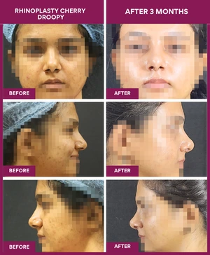 RHINOPLASTY-CHERRY-DROOPY