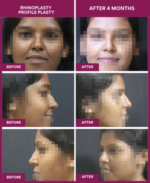 RHINOPLASTY-PROFILE-PLASTY-after-4-months