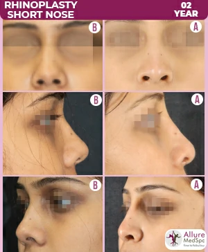 RHINOPLASTY-SHORT-NOSE