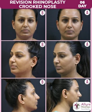 Revision_Rhinoplasty_Crooked_Nose