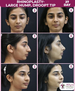 Rhinoplasty-Large_Hump_Droopy_Tip